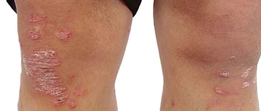 Psoriasis is an uncomfortable skin condition that requires treatment with Keraderm cream