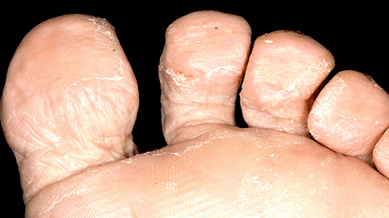 How to recognize the presence of a mushroom between the toes