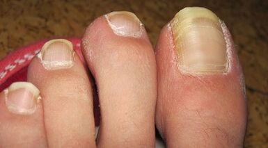 How the mushroom is manifested on the nails
