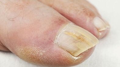 The initial phase of the development of the mushroom on the nails