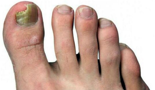 Nail squeezing