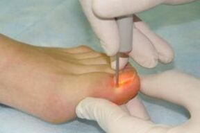 mechanical removal of the nail in case of fungal infection
