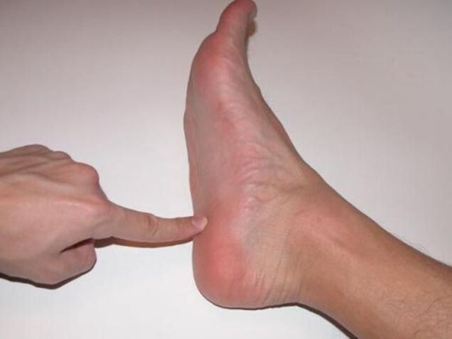 Foot pain caused by toenail fungus