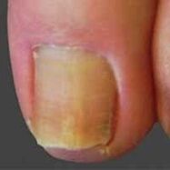 Yeast lesions of the nail