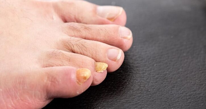 Yellowing of the nails due to athlete's foot