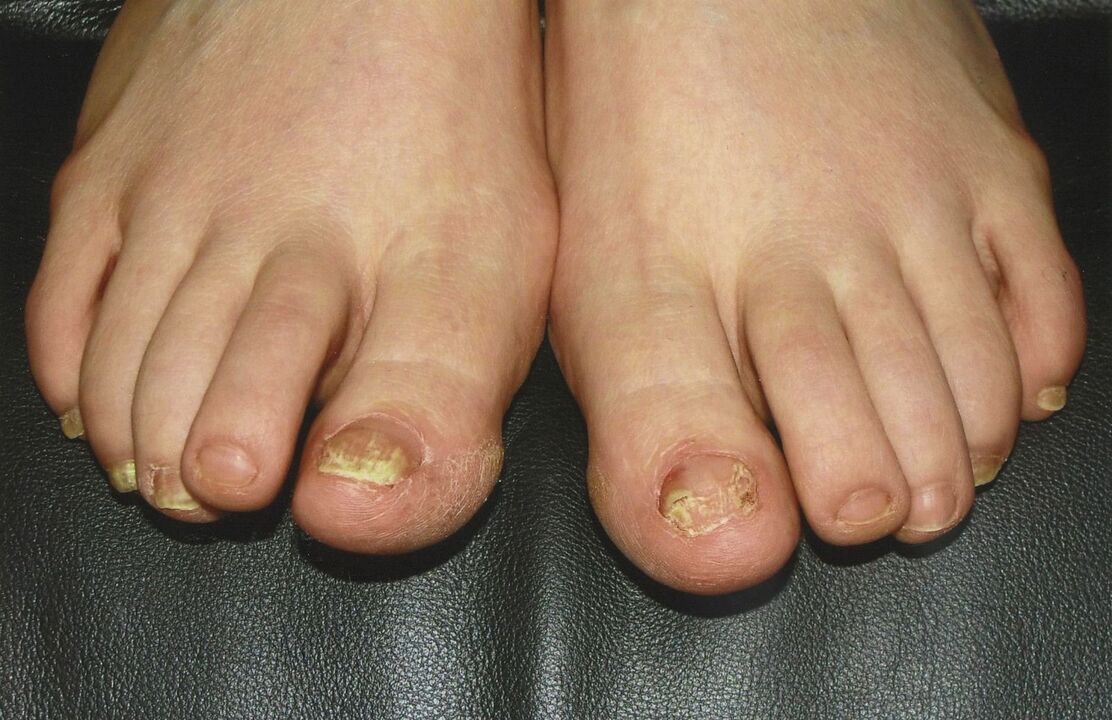 How to treat toenail fungus with nail polish