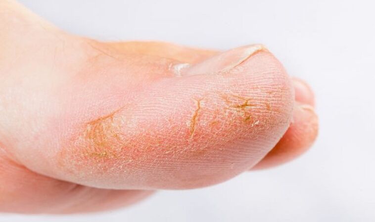 Symptoms of skin fungus on the feet