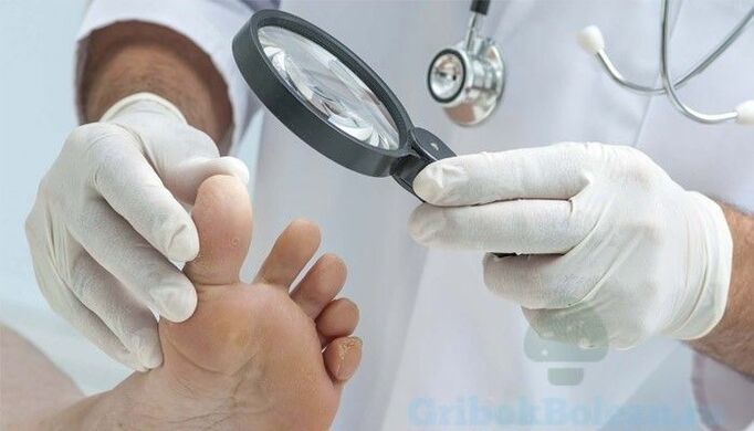 Diagnosis of athlete's foot by a doctor