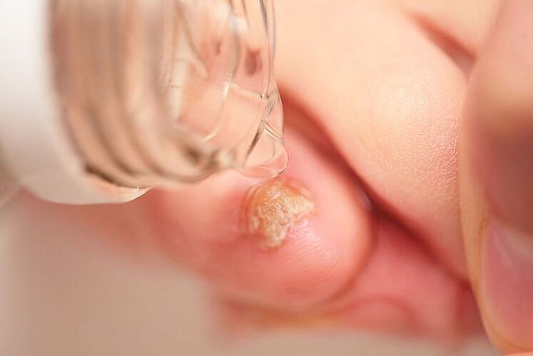 How does hydrogen peroxide affect fungi