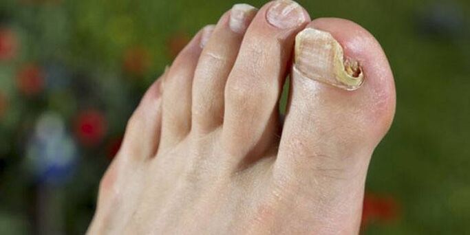 Fungus on big toenail