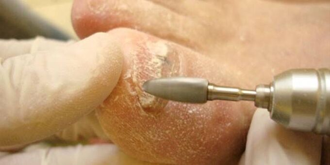 Removal of nail fungus