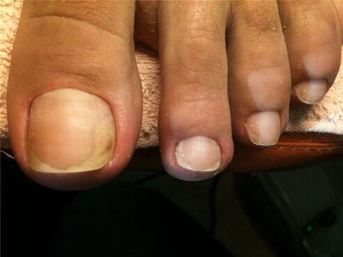 Fungal infection of the nail plate