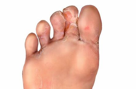 Symptoms of a fungus between the toes