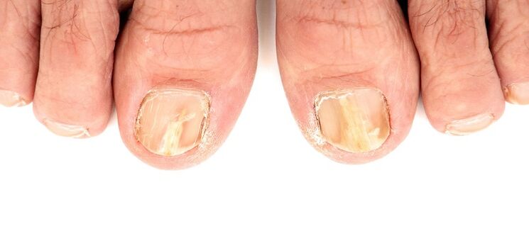 Damage to the nail plate from fungus