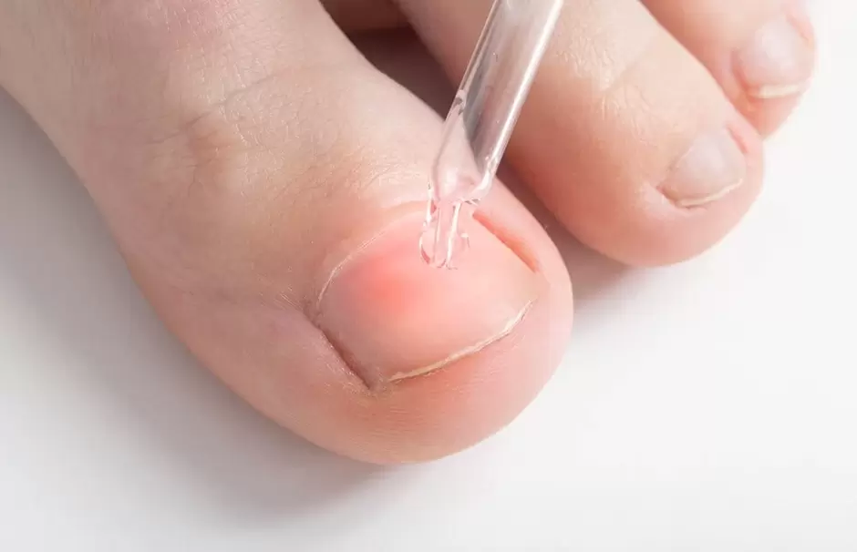 Treating onychomycosis with an antifungal solution