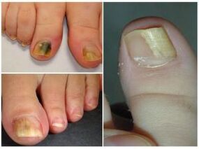 Appearance of toenails in onychomycosis