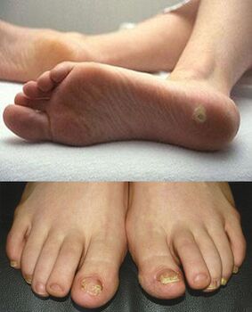 Manifestations of mycosis on the skin and nails of the feet