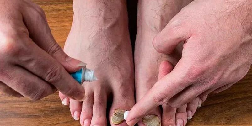 Causes of fungus between toes