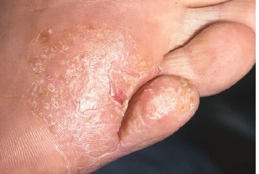 Manifestations of fungal infection of the skin of the feet