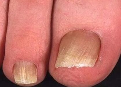Nail fungus on the legs of the starting level