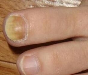 Symptoms of the initial stage of nail fungus